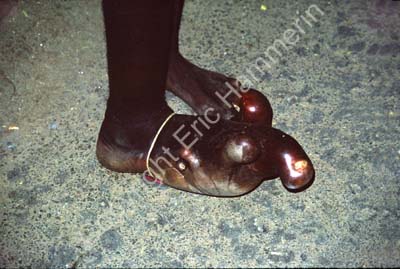 Man with elephantiasis foot 826814